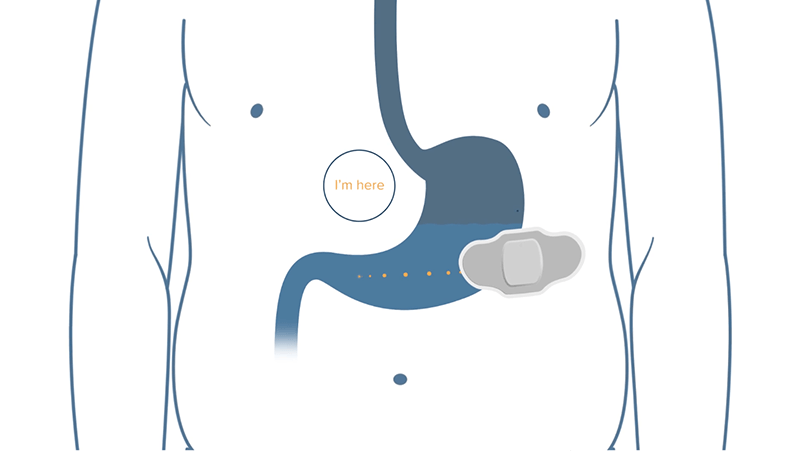 Iott Smart Pills Proteus